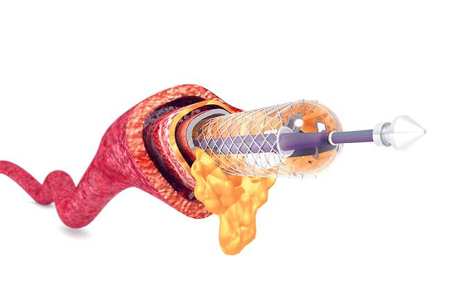 스텐트 시술. 게티이미지뱅크