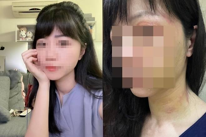 대만의 집권 민진당 가오자위(40) 의원이 애인에게 데이트 폭력을 당한 사실을 털어놨다. 왼쪽이 가고 의원의 평소 모습, 오른쪽이 폭행을 당한 후 붓고 멍들은 얼굴. /사진=가오자위 의원 SNS, 가오자위 의원실