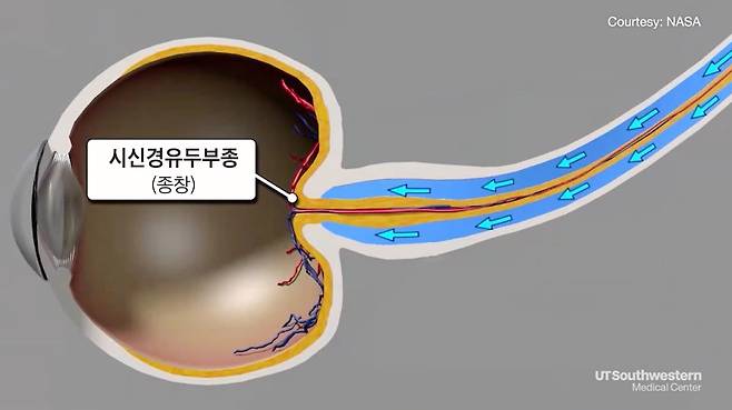 중력이 거의 없는 우주에서는 눈 뒤로 체액이 계속 몰려와 안구를 납작하게 하고 신경을 부풀린다. 이로 인해 시력이 손상된다./미 텍사스대