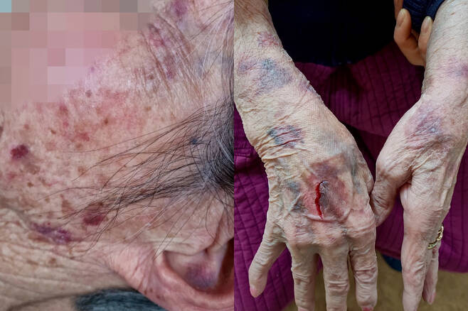 80대 노인 가족이 공개한 폭행 피해 사진 / 사진=온라인 커뮤니티 캡처