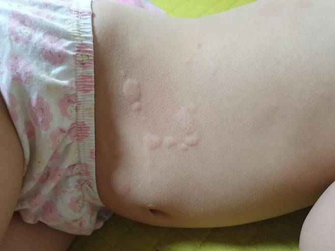 권연벌레가 나온 샴푸를 사용해 알레르기 반응이 올라왔다고 주장되는 사진 / 사진=보배드림