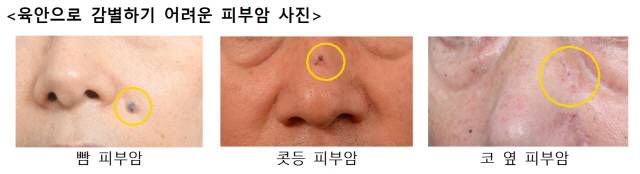 피부암은 맨눈으로 감별하기 어려워, 점점 커지는 점이 있다면 조직 검사를 해보는 것이 좋다./사진=가천대 길병원