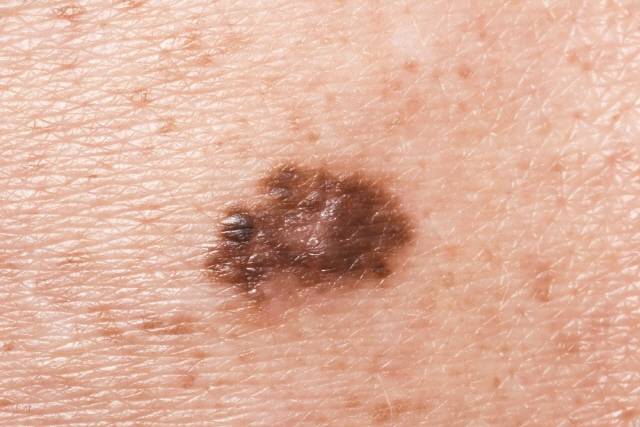 피부암은 모양이 비대칭이고 색이 균일하지 않은 경우가 많다./사진=클립아트코리아