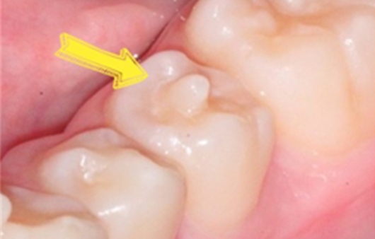 치외치 | 출처: 연세휴치과 동부이촌점