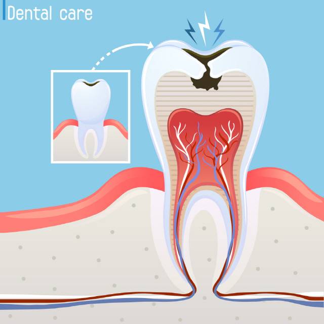 충치 치료 후 수일 내 이시림·통증이 생기는 것을 '술후 과민증'이라고 한다./클립아트코리아 제공