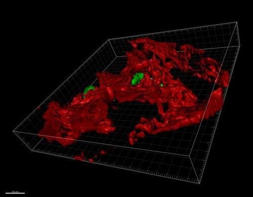 생쥐의 뼈에 전이한 유방암 세포  뼈 조직에 전이한 ZEB 1 발현 유방암 세포(녹색)의 3D 이미지.
ZEB 1 단백질은 암세포의 환경 적응 능력을 제어하며, 암세포가 전이 방향을 결정하는 데 영향을 미친다.
[스위스 제네바 의대 디디어 피카르트 교수 제공. 재판매 및 DB 금지]