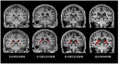 뇌 영상에서 맥락얼기의 부피(빨간색)가 치매가 진행함에 따라 더 증가한 것을 확인할 수 있다./사진=건국대병원