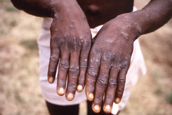 원숭이두창에 감염된 아프리카 한 환자의 손. [AP=연합뉴스]