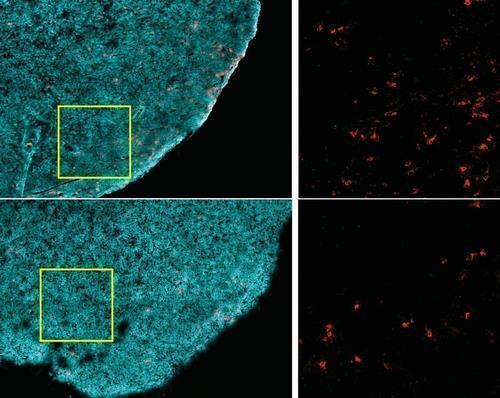 암세포 파괴하는 T세포와 비만 암세포만 골라 죽이는 CD8+ T세포(적색)는, 비만한 생쥐(하단)보다 그렇지 않은 생쥐(상단)의 종양에 훨씬 더 많다. 
살이 찌면 암에 맞서는 면역력이 약해진다는 뜻이다.
[하버드의대 Ringel 등 제공. 재판매 및 DB 금지]