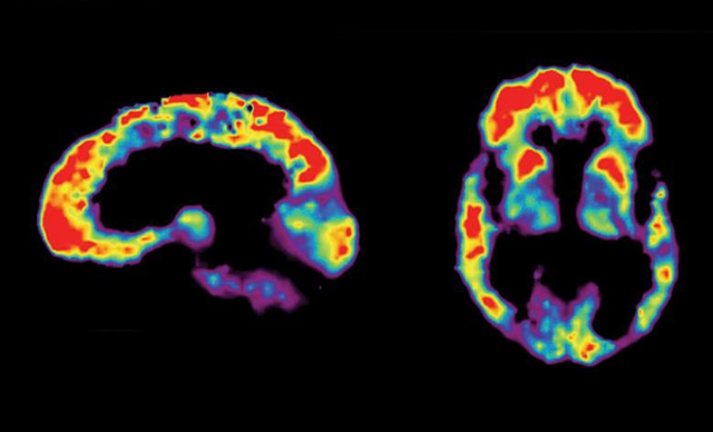 알츠하이머 치매 환자의 뇌를 양전자방출단층촬영(PET)으로 확인한 영상이다. 윗부분이 아밀로이드베타 농도가 높은 부위. 미국국립보건원(NIH) 제공