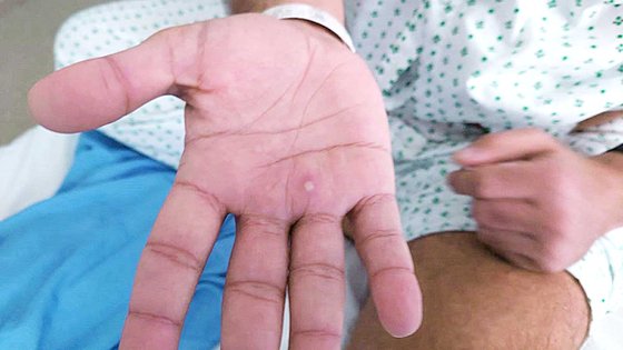 원숭이두창 감염자의 손에 나타난 증상. 로이터=연합뉴스
