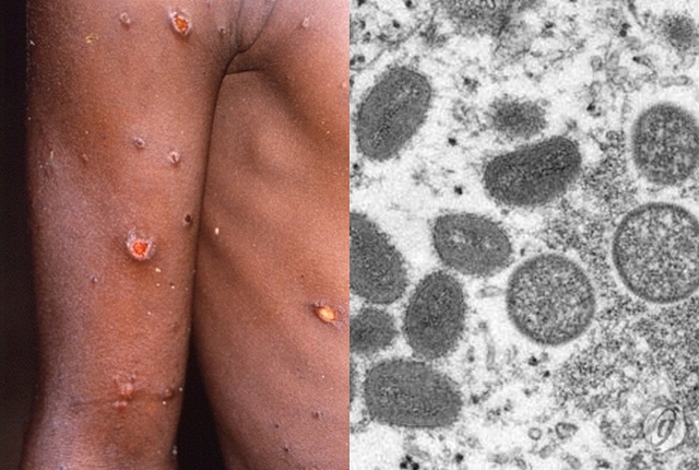 1996∼1997년 아프리카 콩고의 원숭이두창 환자. 오른쪽 사진은 전자현미경에 포착된 원숭이두창 바이러스입자 모습. 로이터, AP 연합뉴스