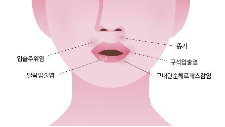 입술 주변엔 물집이나 뾰루지가 잘 생기는데, 위치에 따라 질환 종류가 달라 주의해야 한다./사진=을지병원 제공