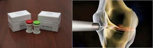 인보사 제품 사진(왼쪽)과 인보사 치료 이미지. /코오롱생명과학