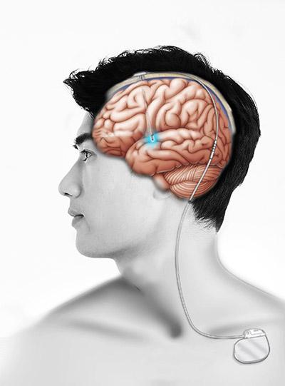 뇌심부자극술로 자극용 전극 삽입한 모식도. 서울대병원 제공