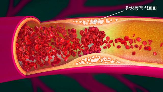 관상동맥 석회화./사진=강북삼성서울병원