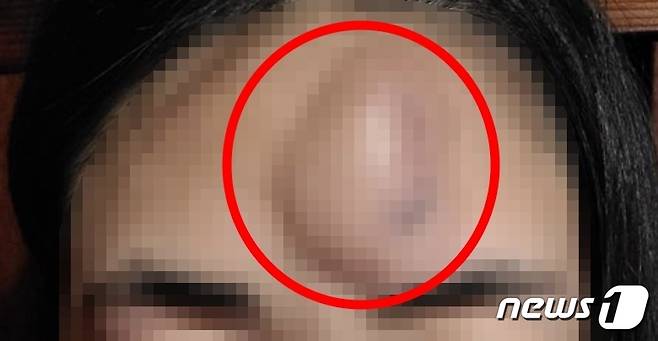 A씨는 남성의 폭행으로 B씨 이마에 혹이 생겼다고 주장했다. (온라인 커뮤니티 갈무리)
