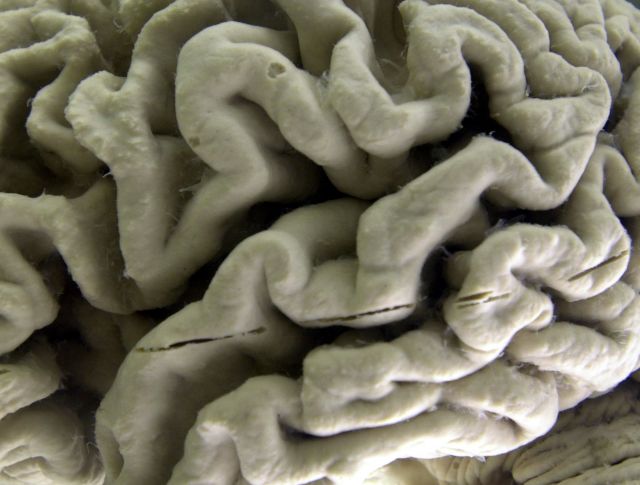 알츠하이머에 걸린 인간의 뇌. AP연합뉴스