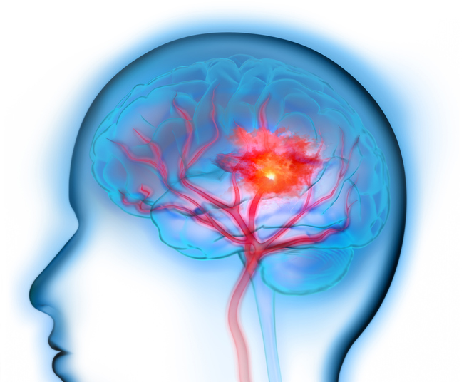 뇌출혈은 동맥에서 나온 피가 갑자기 뇌로 흐르면서 발생한다. [사진= 게티이미지뱅크]