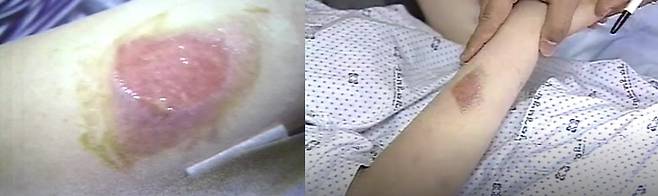 2006년 학폭 피해자 정양이 고데기 열로 입은 상처. (MBC 갈무리)
