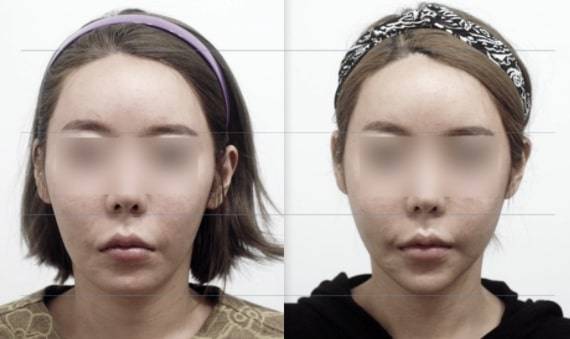 턱끝의 길이는 살짝 늘었지만 얼굴의 긴 느낌은 좋아졌다.