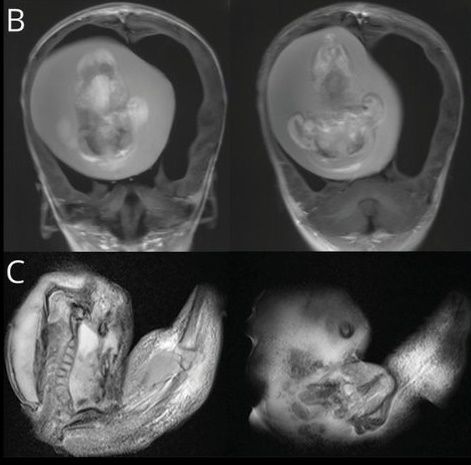 중국의 한 갓난아이 두개골에서 발견된 기생 태아. /@GreenJournal 트위터