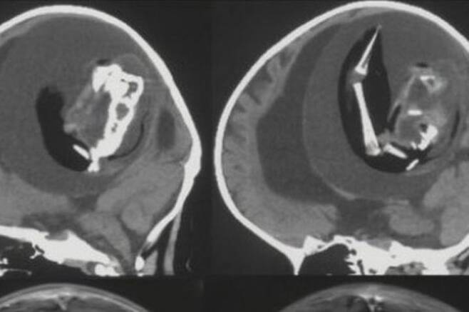 [서울=뉴시스] 중국 푸단 대학 병원에서 촬영한 익명 아이의 CT 사진, 의료진은 대두증을 앓고 있던 아이의 두개골 안쪽에서 '쌍둥이 태아'를 발견했다 (사진출처: 트위터 갈무리) 2023.03.10. *재판매 및 DB 금지