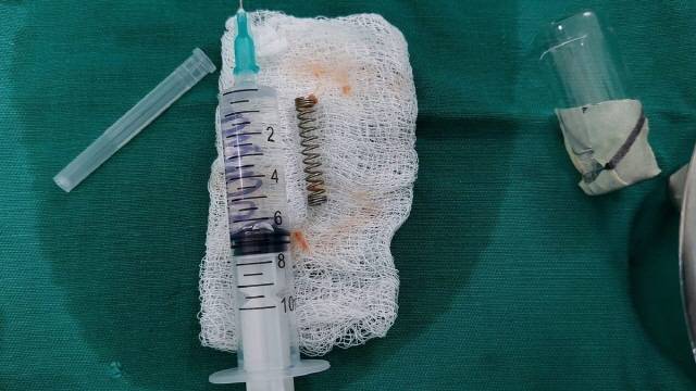 5세 남아 폐에서 발견된 금속 스프링/사진=더 미러