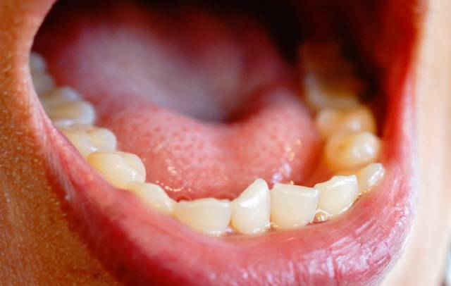 입을 다물었을 때 혀는 입천장에 닿아 있어야 한다. 혀끝이 아랫니 뒤에 가 있는 사람은 무의식중에 혀로 아랫니를 밀게 돼 주걱턱이 될 수 있다./사진=게티이미지뱅크