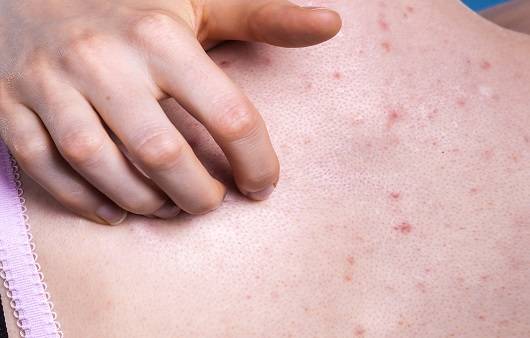 등 여드름은 다양한 원인에 의해 생길 수 있다|출처: 게티이미지뱅크