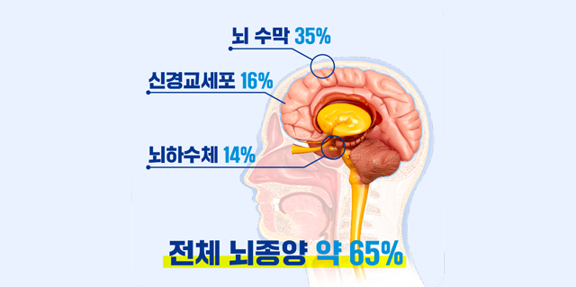 뇌종양의 세부 유형. 전체 뇌종양의 65%는 뇌수막, 신경교세포, 뇌하수체에 발생한다. 사진 제공=분당서울대병원