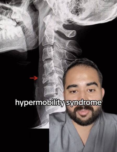목을 무리하게 꺾으면 고운동성 증후군에 의한 압박골절이 발생할 수 있다. [사진=틱톡/everariasmd[