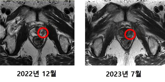 지난 4~5월 국내에서 처음으로 중입자치료를 받은 최모 씨의 MRI 촬영 비교 사진. 기존에 발견됐던 암 조직(왼쪽 사진 표시)이 치료 후(오른쪽 사진 표시)에는 발견되지 않았다. /사진=연세암병원