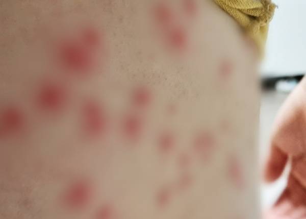 인천 연수구 송도국제도시의 한 초등학교에서 생존수영 수업을 받고 피부염에 걸린 학생 모습. 독자 제공