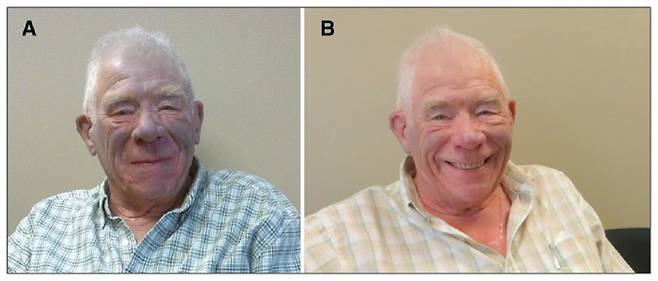 은이 들어간 약물에 의해 피부가 파랗게 변한 남성의 모습(왼쪽)과 복용 중단 1년 후 극적으로 피부색이 돌아온 모습(오른쪽)./사진=Canadian Medical Association Journal