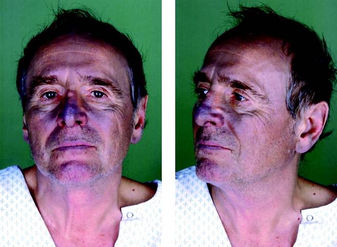 은이 들어간 약물에 의해 코, 입술, 볼 등이 파랗게 변하기 시작한 남성의 모습./사진=American Heart Association