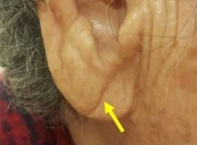귓불에 대각선 주름이 있다면 치매의 위험을 알리는 신호일 수 있다./사진=Diagonal Earlobe Crease is a Visible Sign for Cerebral Small Vessel Disease and Amyloid-β