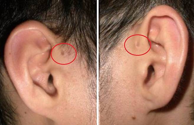 귀 옆에 작은 구멍이 있다면 선천성 이루공을 의심해야 한다./사진=Korean Journal of Otorhinolaryngology-head and Neck Surgery