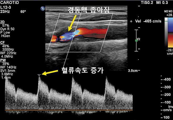 경동맥 초음파는 혈관 벽 내막·중간막 두께와 혈류 속도를 측정해 협착 정도를 진단한다. /이태규신경과의원 제공