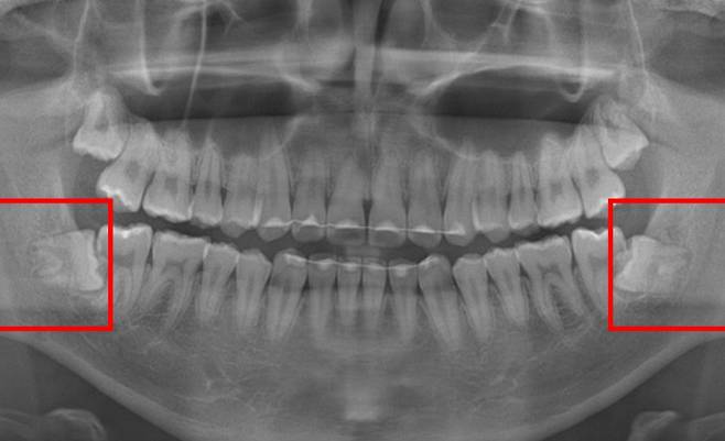 사랑니로 인해 인접치가 손상된 모습 / 서울대치과병원 제공