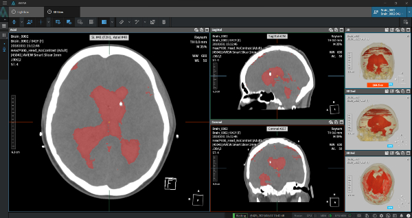뇌출혈 뇌 영상 검출·진단 보조 소프트웨어 'AVIEW NeuroCAD' /자료=코어라인소프트