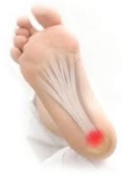 족저근막염은 발뒤꿈치뼈 아래 발바닥 쪽에서 통증이 나타나는 경우가 대부분이다. 경향신문DB