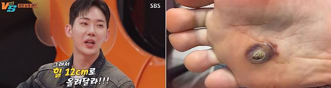 가수 겸 뮤지컬 배우 조권(34)이 하이힐을 신다가 티눈이 생겨 대수술을 받았다고 밝혔다./사진=SBS 예능 프로그램 ‘강심장VS’ 캡처