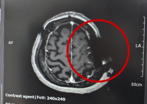 톱날이 박힌 머리뼈 동그라미 부근의 머리뼈에 쇠톱 날이 박혀 자기공명영상(MRI)이 제대로 찍히지 않았다. MRI는 자기공명을 이용하는데 금속 물질이 있어 정상적으로 작동하지 않았다고 한다. [B씨 제공]
