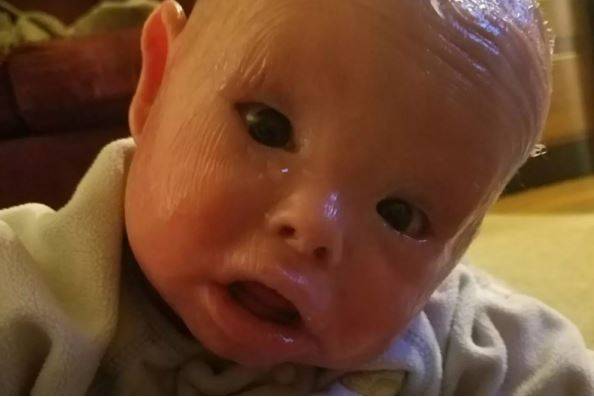 할리퀸 어린선은 어린선의 일종이지만, 그 정도가 심해 사망까지 이를 수 있는 치명적인 피부질환이다./사진=피플