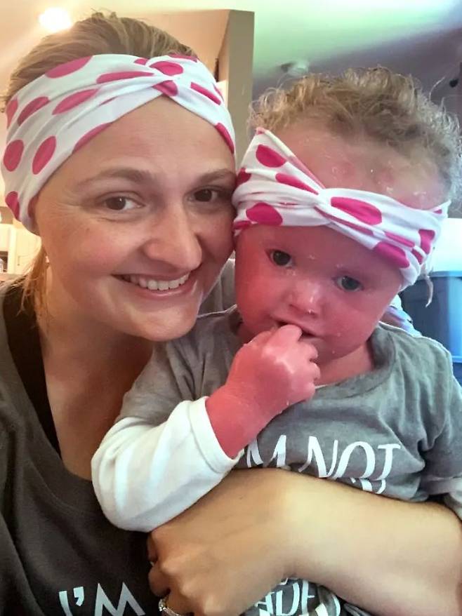 할리퀸 어린선을 앓고 있는 안나 라일리와 어머니의 모습./사진=뉴욕 포스트