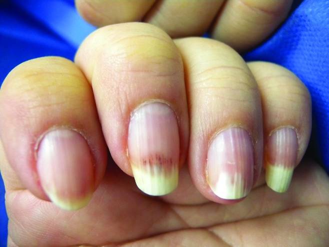네일아트를 반복적으로 하면 손톱이 약해져 ‘조갑연화증’이나 ‘조갑박리증’이 생길 수 있다. 네일아트 때문에 조갑박리증이 나타난 모습./사진=Journal of Clinical and Aesthetic Dermatology