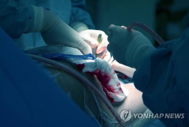 제왕절개수술. 연합뉴스