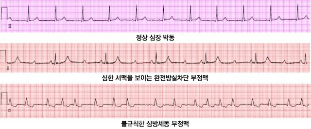 정상 심장 박동(위쪽부터)과 심한 서맥을 보이는 완전방실차단 부정맥, 불규칙한 심방세동의 심전도 그래프. 사진 제공=서울아산병원