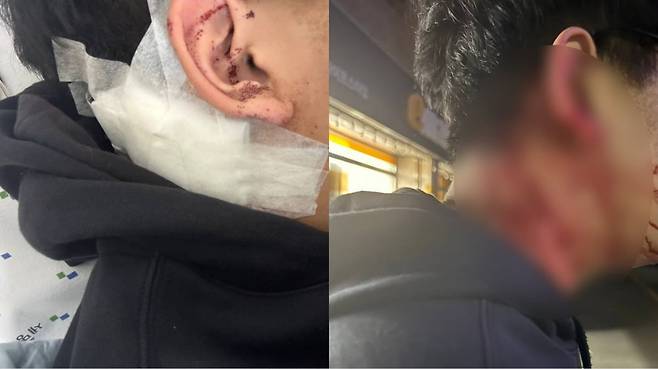 피해자 김모 씨(19)가 목덜미에 입은 상처. /사진=독자 제공